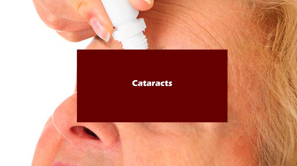 cataracts