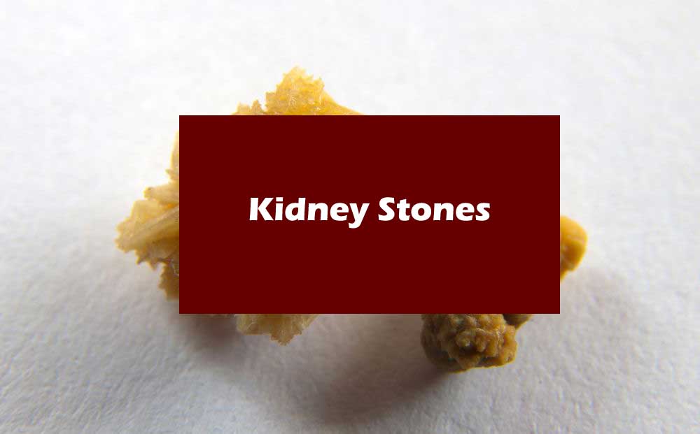 Kidney Stones - Healthcare