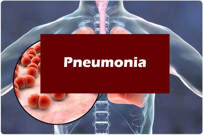 pneumonia