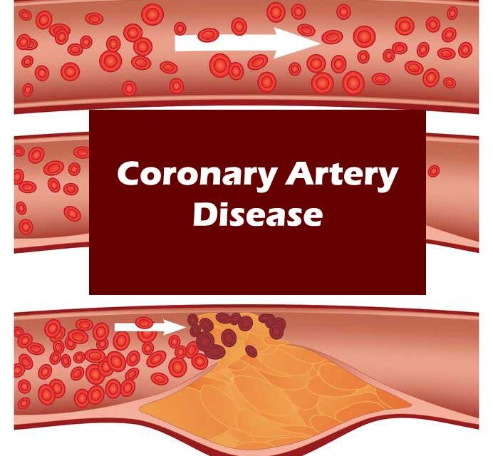 Living with Coronary Artery Disease