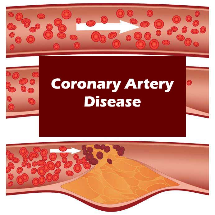 coronary heart disease