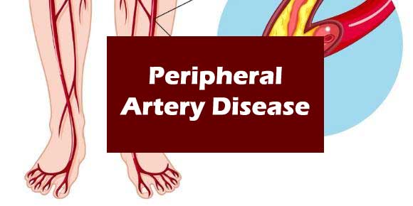 Peripheral Artery Disease